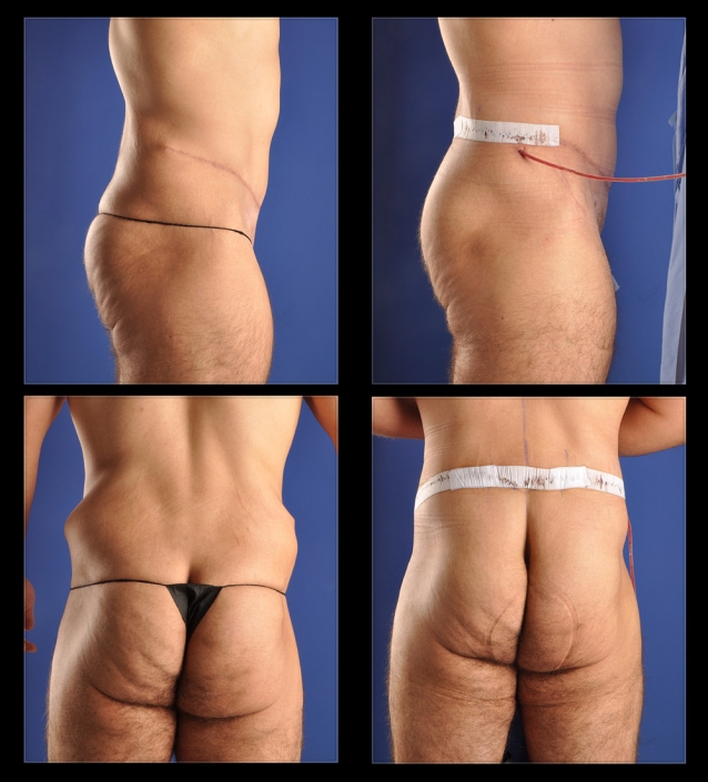 Male Post Bariatric Surgery Before And After Photos Los Angeles