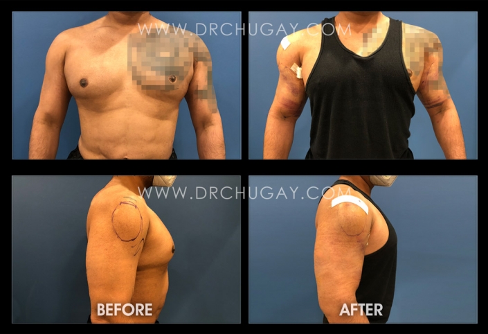 42yo male before and 1 day after biceps, triceps, deltoid implants. Despite significant bruising, a more muscular appearance is achieved. Size 1 biceps implants. Size 25 triceps. Size 2 deltoid.