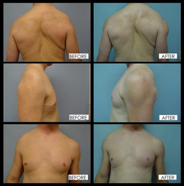 Male Deltoid Implants - Plastic Surgery for Men - Muscle Implants - Before and After Photos - Los Angeles