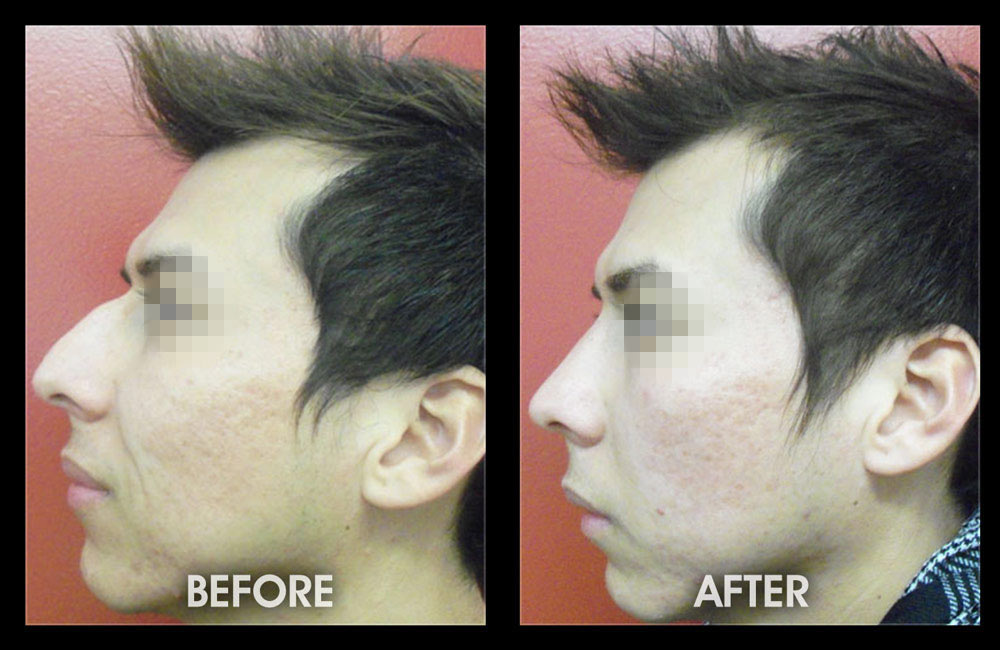 Example of a successful, closed rhinoplasty (nose job) procedure by Dr. Chugay